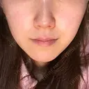 脂肪溶解注射（顔） / その他（肌） The-Clim産婦人科  DAY 17 サムネイル用