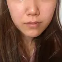 脂肪溶解注射（顔） / その他（肌） The-Clim産婦人科  DAY 20 サムネイル用