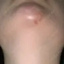 糸リフト / ヒアルロン酸注入（あご） / 脂肪溶解注射（顔） リエンジャン整形外科 江南店 DAY 9 サムネイル用