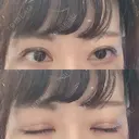 眼瞼下垂（切開） 札幌中央形成外科 DAY 48 サムネイル用
