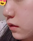 スレッドノーズ リエンジャン整形外科 江南店 AFTER サムネイル用