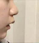 スレッドノーズ リエンジャン整形外科 江南店 DAY 8 サムネイル用