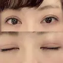 眼瞼下垂（切開） 札幌中央形成外科 DAY 49 サムネイル用