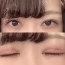 眼瞼下垂（切開） 札幌中央形成外科 DAY 50 サムネイル用