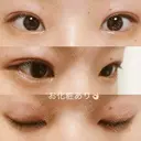 二重埋没 湘南美容クリニック 大阪堺東院 DAY 22 サムネイル用