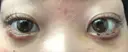 その他（目元） コムロクリニック 東京銀座院 DAY 4 サムネイル用