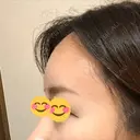 額を丸く / 脂肪注入（額） / 再生医療 / PRP皮膚再生療法 エートップ美容整形外科 AFTER サムネイル用