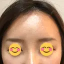 額を丸く / 脂肪注入（額） / 再生医療 / PRP皮膚再生療法 エートップ美容整形外科 DAY 14 サムネイル用