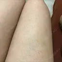 額を丸く / 脂肪注入（額） / 再生医療 / PRP皮膚再生療法 エートップ美容整形外科 DAY 14 サムネイル用