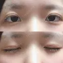 二重切開 / 上まぶたの脂肪取り 城本クリニック 長崎院 DAY 28 サムネイル用