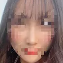 鼻尖形成（切開） / その他（鼻） / 軟骨移植 / 骨切幅寄せ / ワシ鼻修正・ハンプ切除 ソウルクイーン整形外科（旧コエンミ整形外科） DAY 133 サムネイル用
