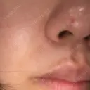 ほくろ・いぼ切除（肌） Mスキンクリニック DAY 6 サムネイル用