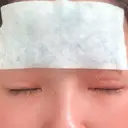 二重埋没 / その他（目元） 湘南美容クリニック 福島院 AFTER サムネイル用
