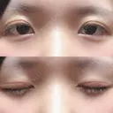 二重切開 / 上まぶたの脂肪取り 城本クリニック 長崎院 DAY 29 サムネイル用