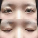 二重切開 / 上まぶたの脂肪取り 城本クリニック 長崎院 DAY 30 サムネイル用