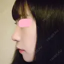 鼻尖形成（切開） / 小鼻縮小（切開） / 軟骨移植 / 骨切幅寄せ HANABI整形外科 DAY 51 サムネイル用