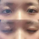 二重切開 / 上まぶたの脂肪取り 城本クリニック 長崎院 DAY 31 サムネイル用