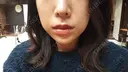 ヒアルロン酸注入（頬） LE CLINIC DAY 14 サムネイル用