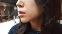 ヒアルロン酸注入（頬） LE CLINIC DAY 14 サムネイル用