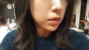 ヒアルロン酸注入（頬） LE CLINIC DAY 14 サムネイル用