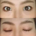 二重埋没 藤・ナチュレ美容クリニック 恵比寿院 AFTER サムネイル用