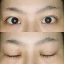 二重埋没 藤・ナチュレ美容クリニック 恵比寿院 DAY 26 サムネイル用