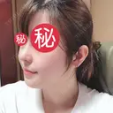 鼻中隔延長（切開） / 骨切り（あご） / 骨削り（エラ） / 軟骨移植 / 眉間プロテーゼ id（アイディ）美容外科 DAY 143 サムネイル用