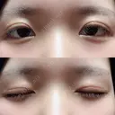 二重切開 / 上まぶたの脂肪取り 城本クリニック 長崎院 DAY 32 サムネイル用