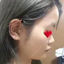 ボトックス（エラ・小顔） / その他（鼻） 湘南美容クリニック 那覇院 DAY 67 サムネイル用