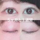 二重埋没 / 目頭切開 かめい美容クリニック宇都宮 DAY 159 サムネイル用