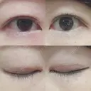 二重埋没 / 目頭切開 かめい美容クリニック宇都宮 DAY 431 サムネイル用