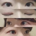 二重埋没 / 目頭切開 かめい美容クリニック宇都宮 DAY 431 サムネイル用