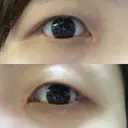脂肪溶解注射（まぶた） 湘南美容クリニック 高松院 DAY 10 サムネイル用