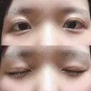 二重切開 / 上まぶたの脂肪取り 城本クリニック 長崎院 DAY 33 サムネイル用