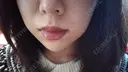 ヒアルロン酸注入（頬） LE CLINIC DAY 19 サムネイル用