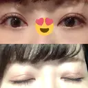 眼瞼下垂（切開） 札幌中央形成外科 AFTER サムネイル用