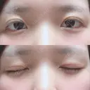 二重切開 / 上まぶたの脂肪取り 城本クリニック 長崎院 DAY 34 サムネイル用