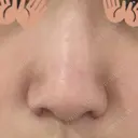 小鼻縮小（切開） 東京ヒルズクリニック 新宿院 DAY 40 サムネイル用