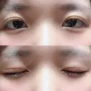 二重切開 / 上まぶたの脂肪取り 城本クリニック 長崎院 DAY 35 サムネイル用