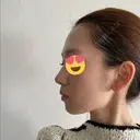 小鼻縮小（切開） / 糸リフト / 鼻尖縮小 / ヒアルロン酸注入（鼻） / ハイフ（顔） ヴェリテクリニック 大阪院 DAY 163 サムネイル用
