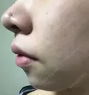 鼻尖形成（切開） / ヒアルロン酸注入（あご） TCB東京中央美容外科 世田谷院 DAY 9 サムネイル用