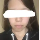 糸リフト / バッカルファット除去 / ボトックス（エラ・小顔） 湘南美容クリニック 静岡院 AFTER サムネイル用