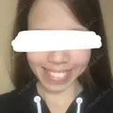 糸リフト / バッカルファット除去 / ボトックス（エラ・小顔） 湘南美容クリニック 静岡院 DAY 92 サムネイル用