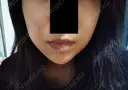 ヒアルロン酸注入（頬） LE CLINIC AFTER サムネイル用