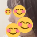 隆鼻術 / 鼻尖形成（切開） / 軟骨移植 HANABI整形外科 DAY 16 サムネイル用