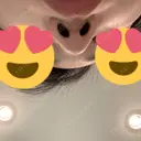 鼻尖形成（切開） / 鼻中隔延長（切開） / その他（鼻） / 軟骨移植 / ボトックス（あご） / ヒアルロン酸注入（あご） / ボトックス（エラ・小顔） / ボトックス（肩） エートップ美容整形外科 DAY 82 サムネイル用