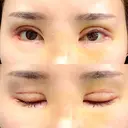 二重切開 / 目頭切開 / その他（目元） / 目尻切開 / タレ目形成・グラマラスライン（切開） id（アイディ）美容外科 DAY 9 サムネイル用