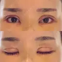 二重切開 / 目頭切開 / その他（目元） / 目尻切開 / タレ目形成・グラマラスライン（切開） id（アイディ）美容外科 DAY 10 サムネイル用