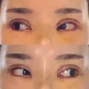 二重切開 / 目頭切開 / その他（目元） / 目尻切開 / タレ目形成・グラマラスライン（切開） id（アイディ）美容外科 DAY 10 サムネイル用