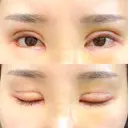 二重切開 / 目頭切開 / その他（目元） / 目尻切開 / タレ目形成・グラマラスライン（切開） id（アイディ）美容外科 DAY 11 サムネイル用